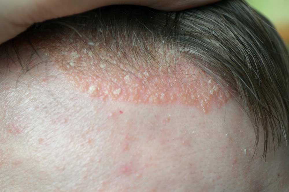 Scalp Psoriasis – Symptoms to Watch out For