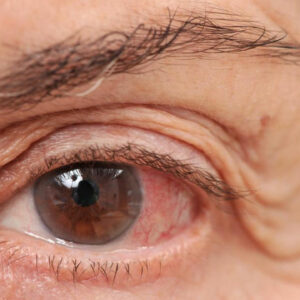 Ways of dealing with chronic dry eye disease